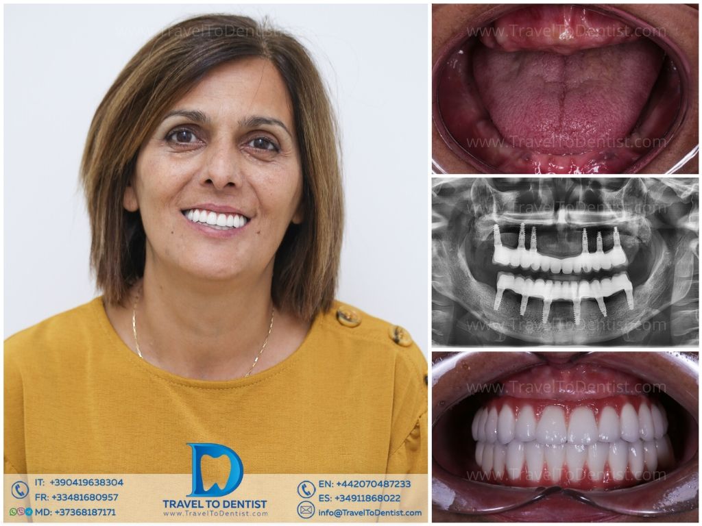 Caso dental 5 - Resultado