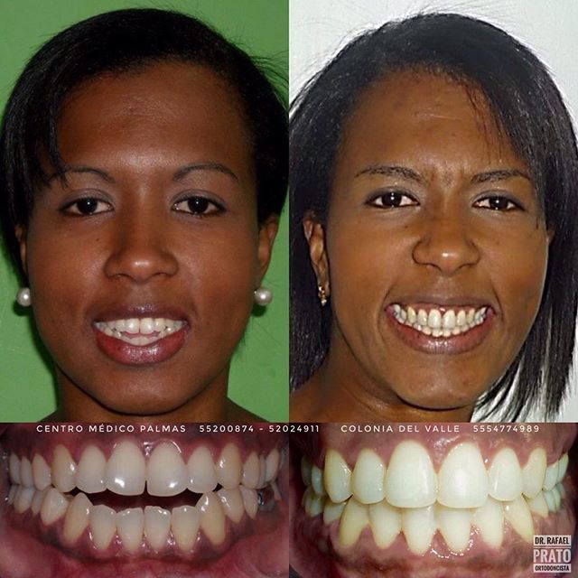 Caso dental 4 - Resultado